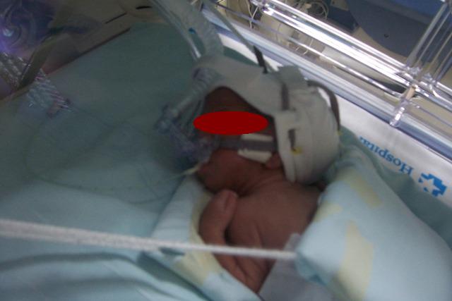 ventilacion no invasiva en neonato